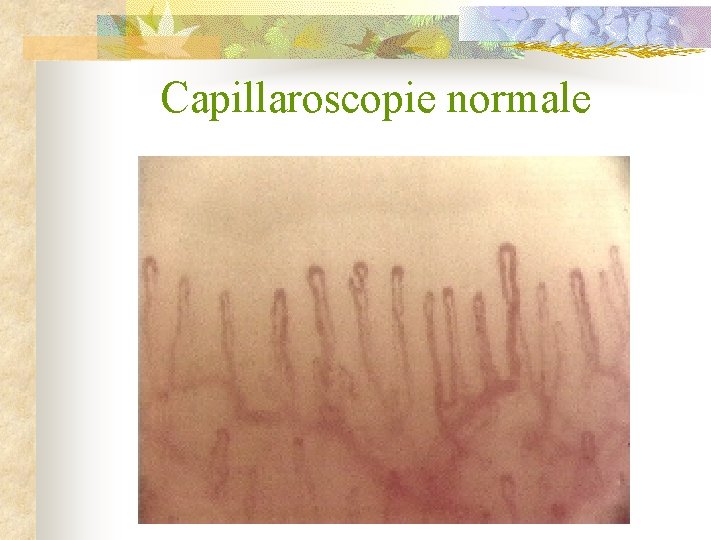 Capillaroscopie normale 