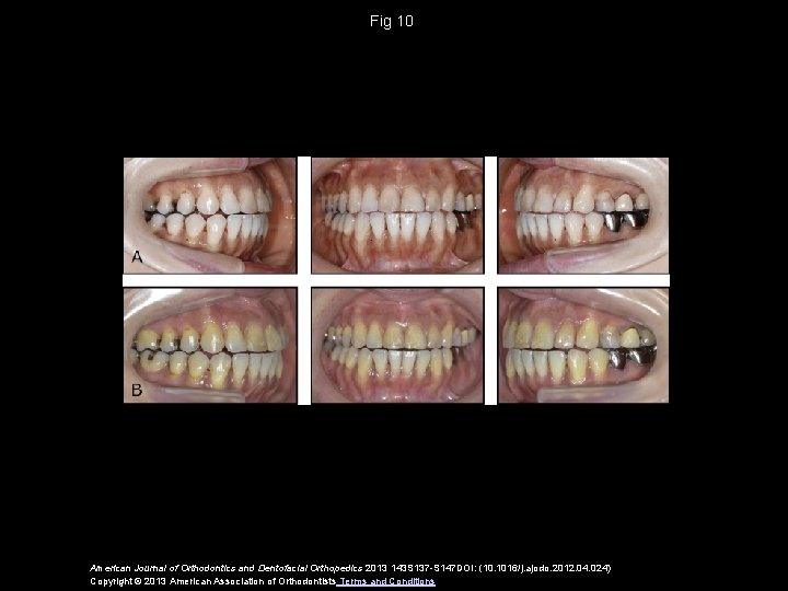 Fig 10 American Journal of Orthodontics and Dentofacial Orthopedics 2013 143 S 137 -S