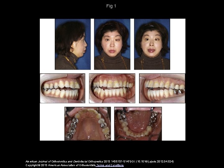 Fig 1 American Journal of Orthodontics and Dentofacial Orthopedics 2013 143 S 137 -S