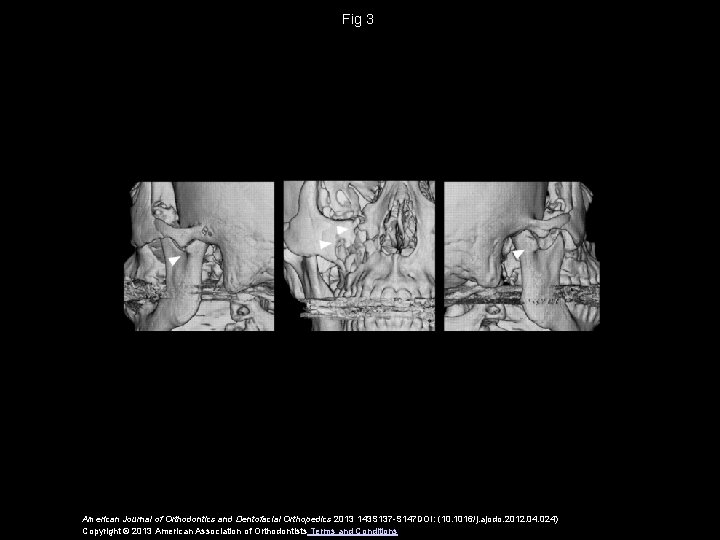 Fig 3 American Journal of Orthodontics and Dentofacial Orthopedics 2013 143 S 137 -S