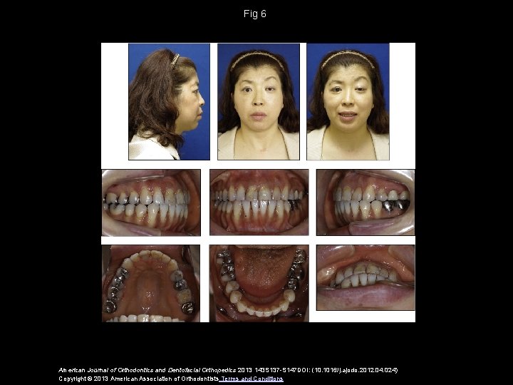 Fig 6 American Journal of Orthodontics and Dentofacial Orthopedics 2013 143 S 137 -S