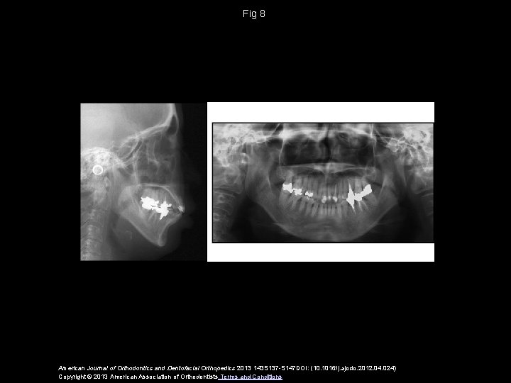 Fig 8 American Journal of Orthodontics and Dentofacial Orthopedics 2013 143 S 137 -S