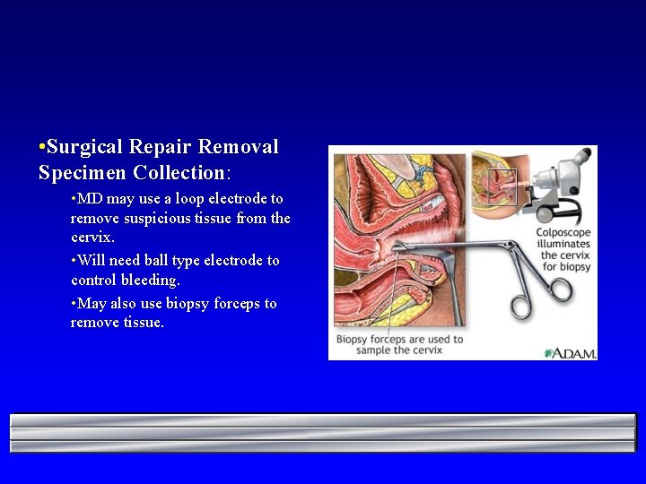  • Surgical Repair Removal Specimen Collection: • MD may use a loop electrode