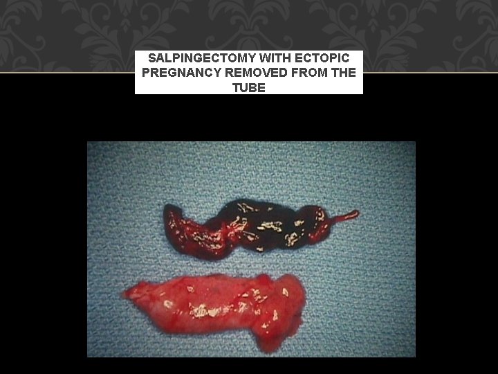 SALPINGECTOMY WITH ECTOPIC PREGNANCY REMOVED FROM THE TUBE 