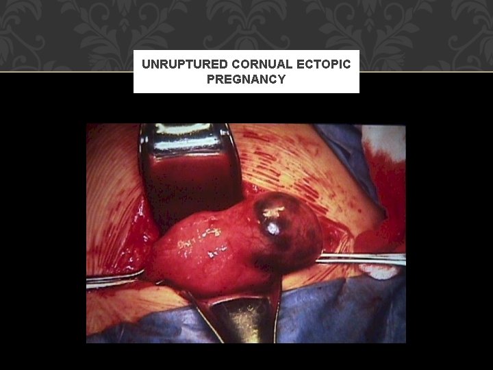 UNRUPTURED CORNUAL ECTOPIC PREGNANCY 