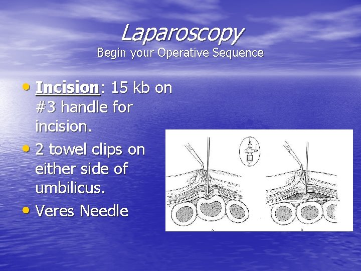 Laparoscopy Begin your Operative Sequence • Incision: 15 kb on #3 handle for incision.