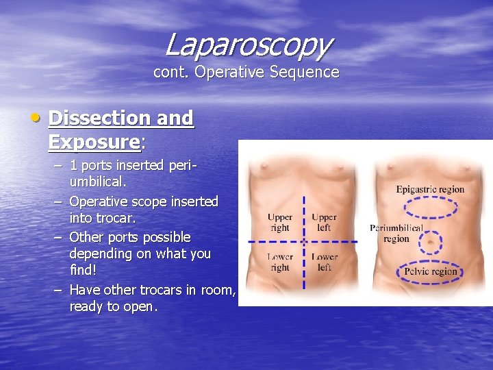 Laparoscopy cont. Operative Sequence • Dissection and Exposure: – 1 ports inserted periumbilical. –