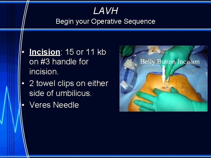 LAVH Begin your Operative Sequence • Incision: 15 or 11 kb on #3 handle