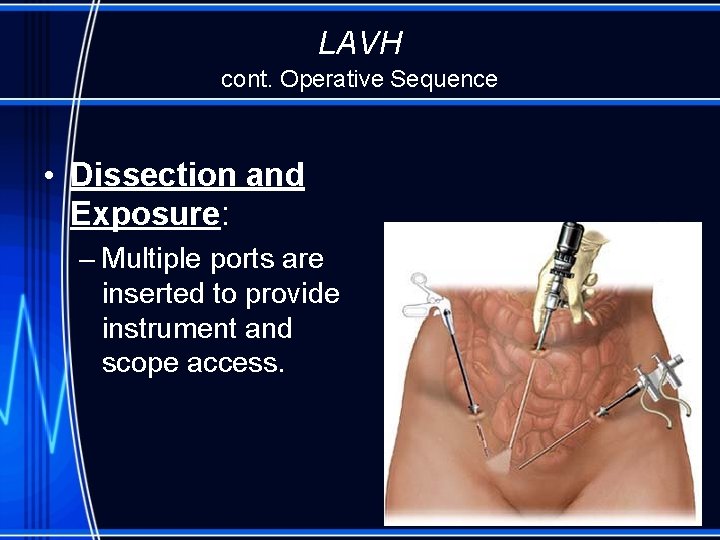 LAVH cont. Operative Sequence • Dissection and Exposure: – Multiple ports are inserted to