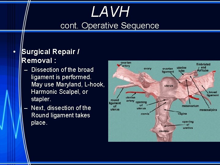 LAVH cont. Operative Sequence • Surgical Repair / Removal : – Dissection of the