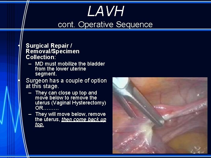  LAVH cont. Operative Sequence • Surgical Repair / Removal/Specimen Collection: – MD must