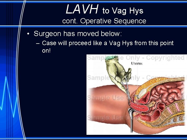 LAVH to Vag Hys cont. Operative Sequence • Surgeon has moved below: – Case