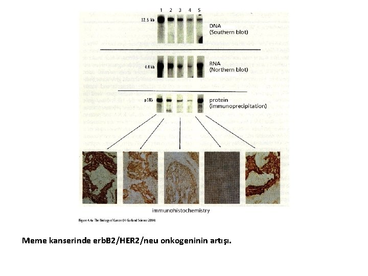 Meme kanserinde erb. B 2/HER 2/neu onkogeninin artışı. 