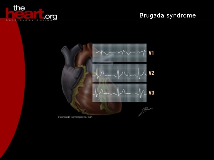 Brugada syndrome 