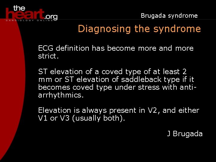 Brugada syndrome Diagnosing the syndrome ECG definition has become more and more strict. ST