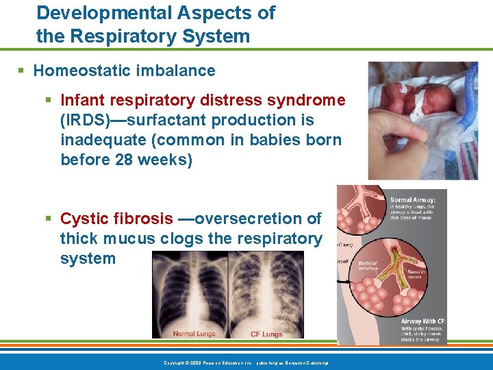 Developmental Aspects of the Respiratory System § Homeostatic imbalance § Infant respiratory distress syndrome