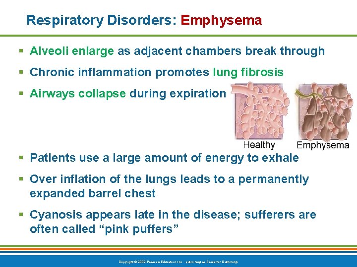 Respiratory Disorders: Emphysema § Alveoli enlarge as adjacent chambers break through § Chronic inflammation