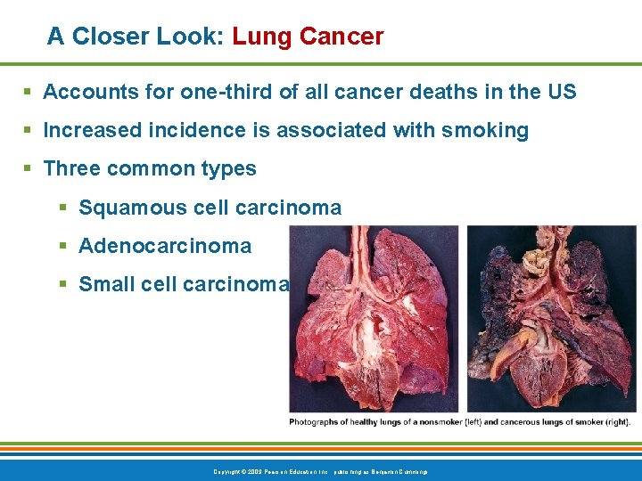 A Closer Look: Lung Cancer § Accounts for one-third of all cancer deaths in
