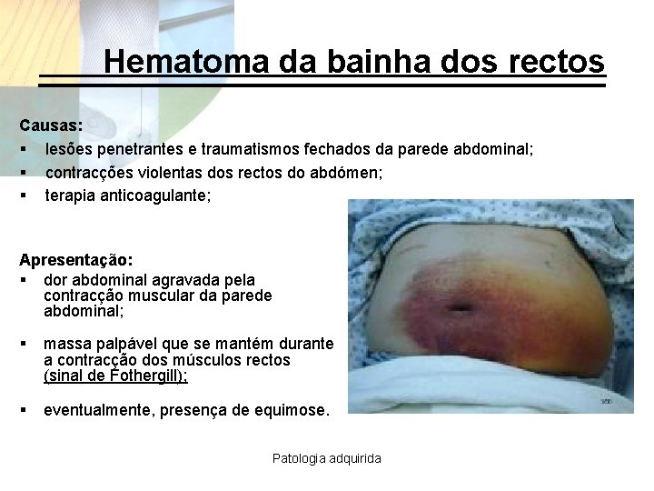 Hematoma da bainha dos rectos Causas: § lesões penetrantes e traumatismos fechados da parede