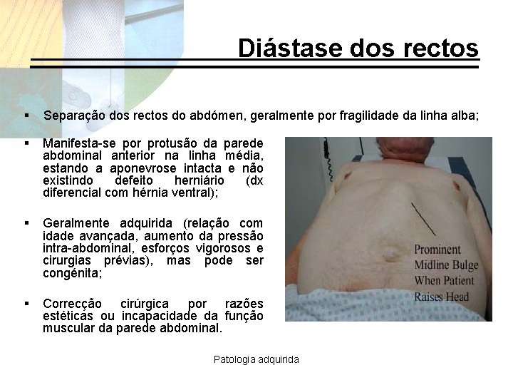 Diástase dos rectos § Separação dos rectos do abdómen, geralmente por fragilidade da linha