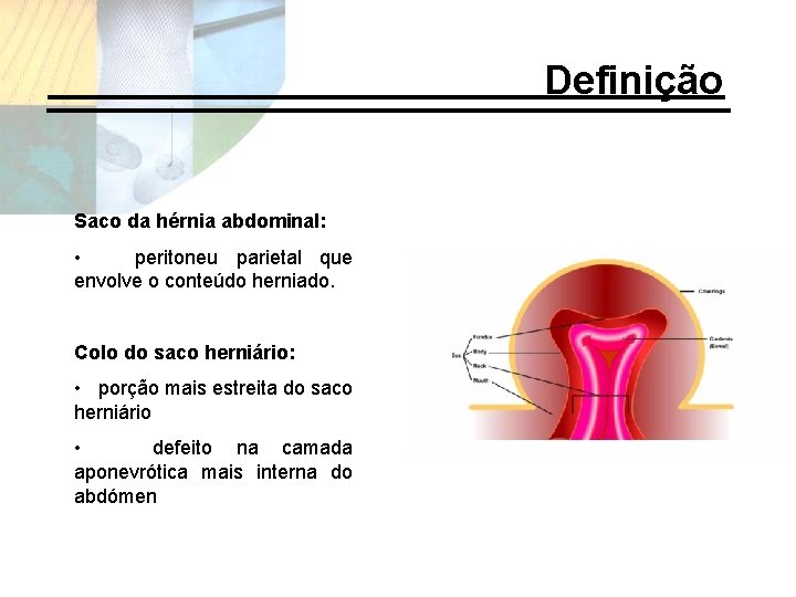 Definição Saco da hérnia abdominal: • peritoneu parietal que envolve o conteúdo herniado. Colo