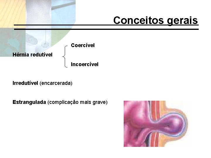 Conceitos gerais Coercível Hérnia redutível Incoercível Irredutível (encarcerada) Estrangulada (complicação mais grave) 