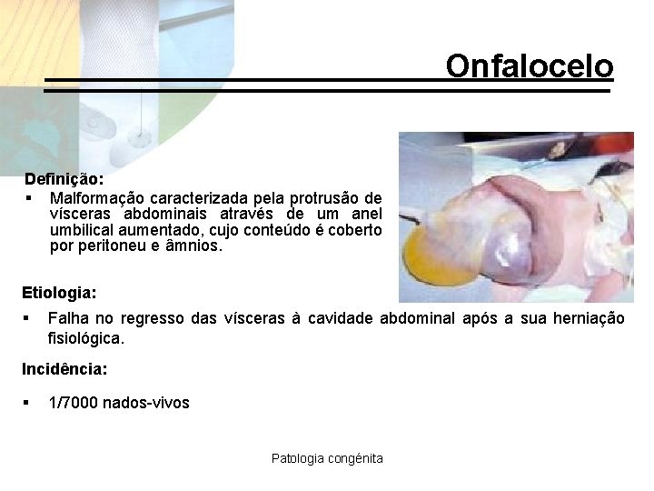 Onfalocelo Definição: § Malformação caracterizada pela protrusão de vísceras abdominais através de um anel