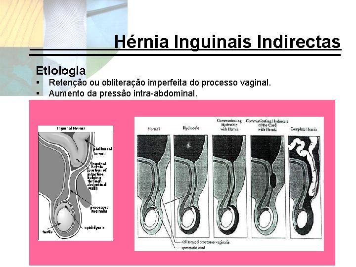 Hérnia Inguinais Indirectas Etiologia § § Retenção ou obliteração imperfeita do processo vaginal. Aumento