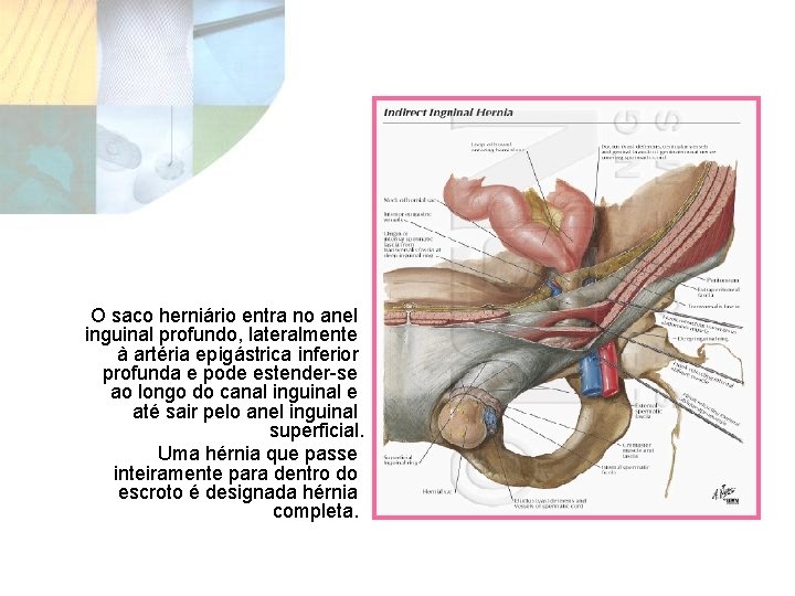 O saco herniário entra no anel inguinal profundo, lateralmente à artéria epigástrica inferior profunda