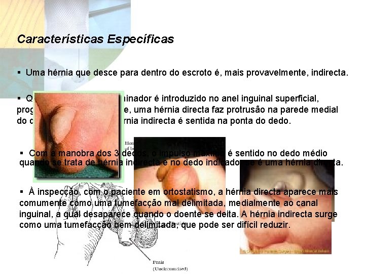 Características Específicas § Uma hérnia que desce para dentro do escroto é, mais provavelmente,