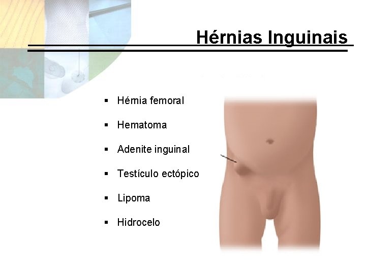 Hérnias Inguinais § Hérnia femoral § Hematoma § Adenite inguinal § Testículo ectópico §