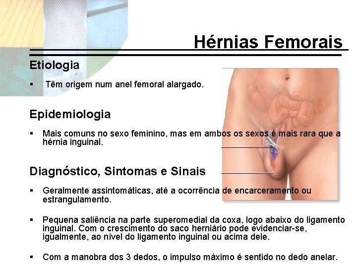 Hérnias Femorais Etiologia § Têm origem num anel femoral alargado. Epidemiologia § Mais comuns