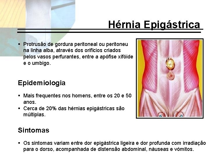 Hérnia Epigástrica § Protrusão de gordura peritoneal ou peritoneu na linha alba, através dos