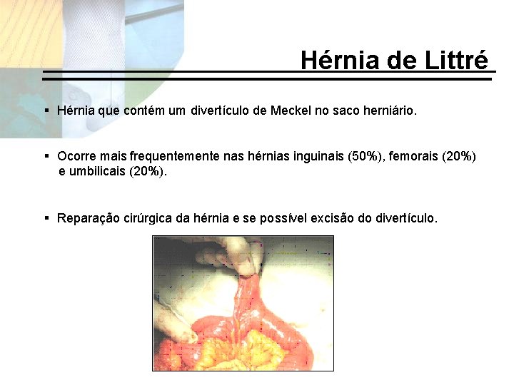 Hérnia de Littré § Hérnia que contém um divertículo de Meckel no saco herniário.