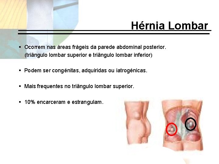 Hérnia Lombar § Ocorrem nas áreas frágeis da parede abdominal posterior. (triângulo lombar superior