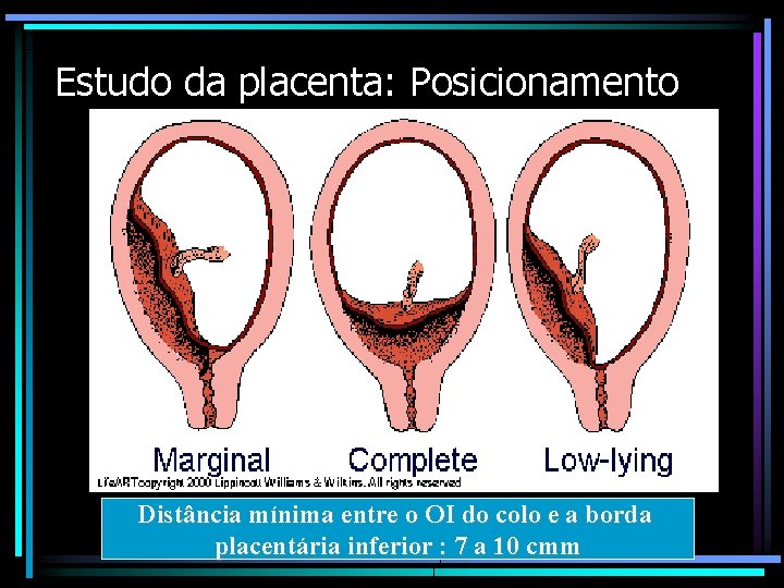 Estudo da placenta: Posicionamento Distância mínima entre o OI do colo e a borda