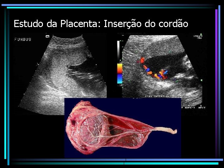 Estudo da Placenta: Inserção do cordão 