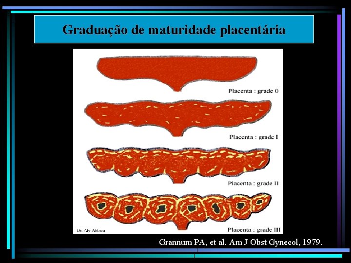 Graduação de maturidade placentária Grannum PA, et al. Am J Obst Gynecol, 1979. 