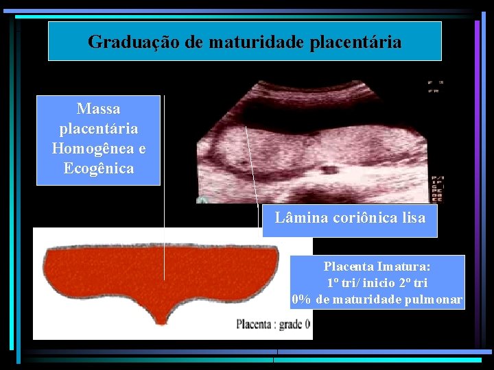 Graduação de maturidade placentária Massa placentária Homogênea e Ecogênica Lâmina coriônica lisa Placenta Imatura: