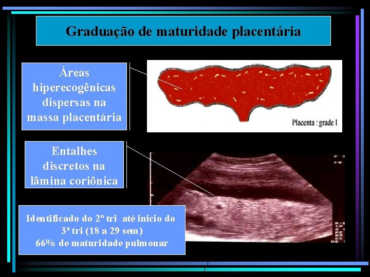 Graduação de maturidade placentária Áreas hiperecogênicas dispersas na massa placentária Entalhes discretos na lâmina