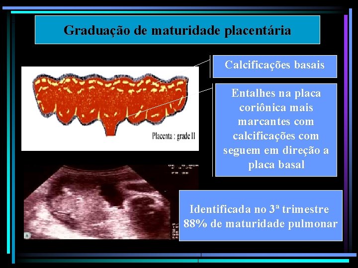 Graduação de maturidade placentária Calcificações basais Entalhes na placa coriônica mais marcantes com calcificações