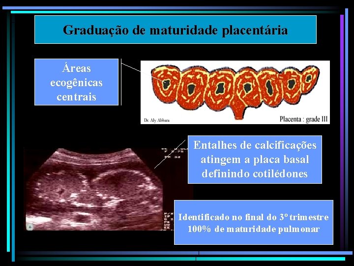 Graduação de maturidade placentária Áreas ecogênicas centrais Entalhes de calcificações atingem a placa basal