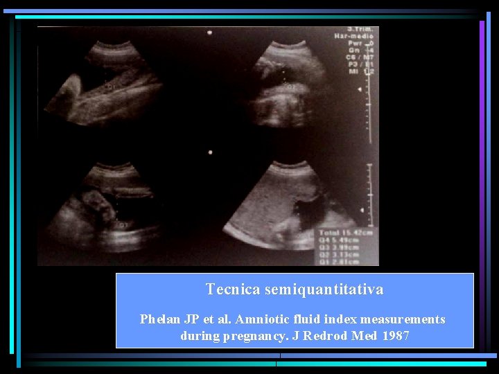 Tecnica semiquantitativa Phelan JP et al. Amniotic fluid index measurements during pregnancy. J Redrod