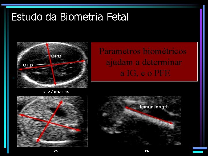 Estudo da Biometria Fetal Parametros biométricos ajudam a determinar a IG, e o PFE