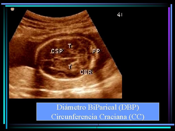 Diámetro Bi. Parieal (DBP) Circunferencia Craciana (CC) 