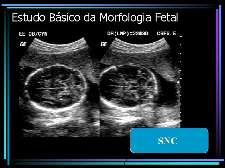 Estudo Básico da Morfologia Fetal SNC 
