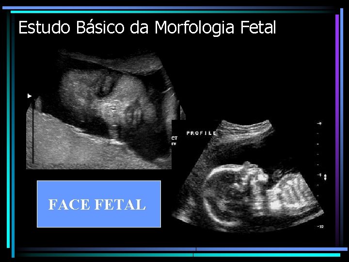 Estudo Básico da Morfologia Fetal FACE FETAL 