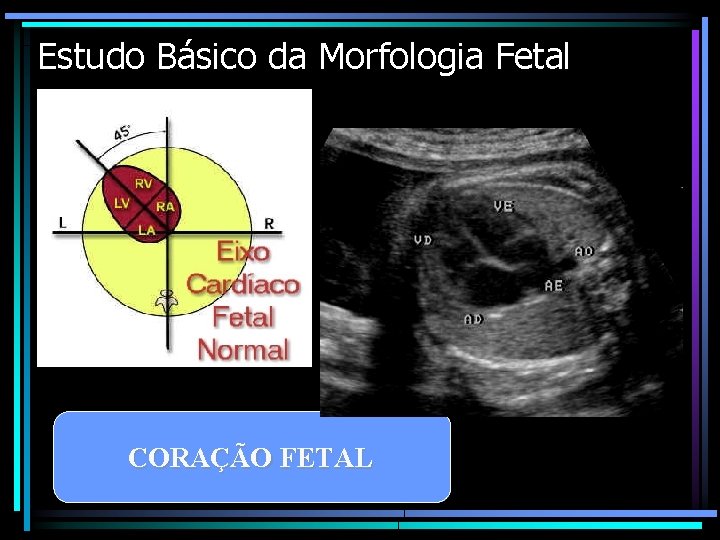 Estudo Básico da Morfologia Fetal CORAÇÃO FETAL 