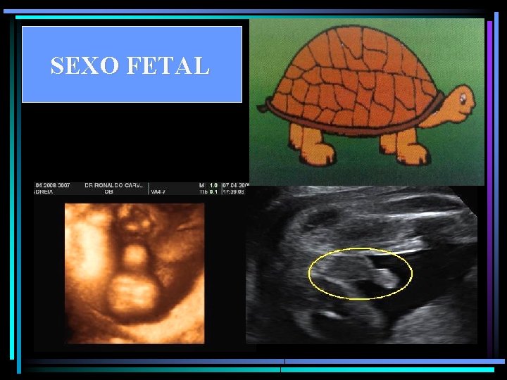 SEXO FETAL 