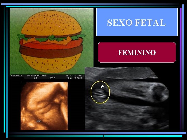 SEXO FETAL FEMININO 